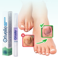 A Natural Way to Eliminate Nail Fungus – For Good